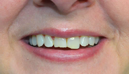 chipped-broken-teeth-before-img