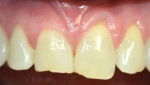 chipped-broken-teeth-before-img