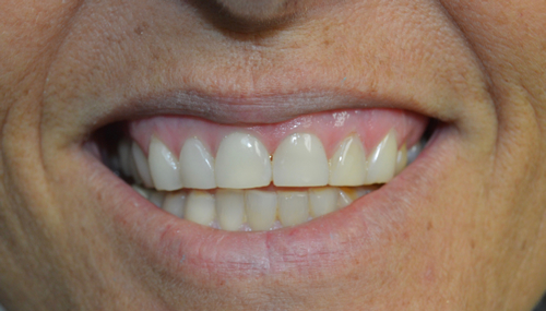 discolored-worn-teeth-after-image