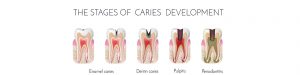 root-canal-banner-img