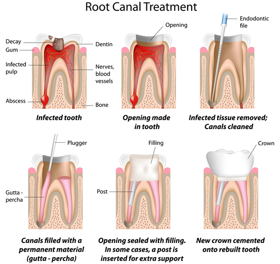 root-canal-treatment-img